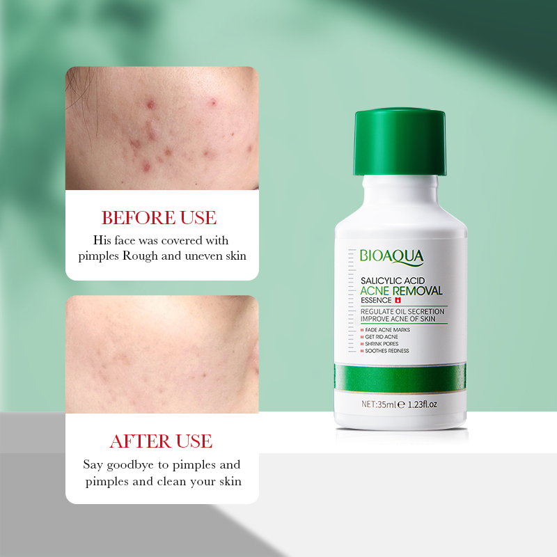 35ml BIOAOUA 살리실산 여드름 제거 에센스 오 - Tranexamic Acid Serum 리뷰 및 가격